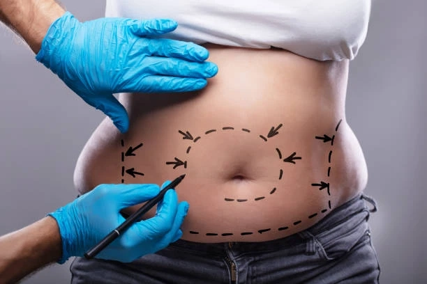 Revamp Your SilhoueRevamp Your Silhouette: Abdominoplasty in Riyadhtte: Abdominoplasty in Riyadh