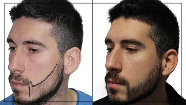 Is beard transplant the best solution for promoting hair growth?