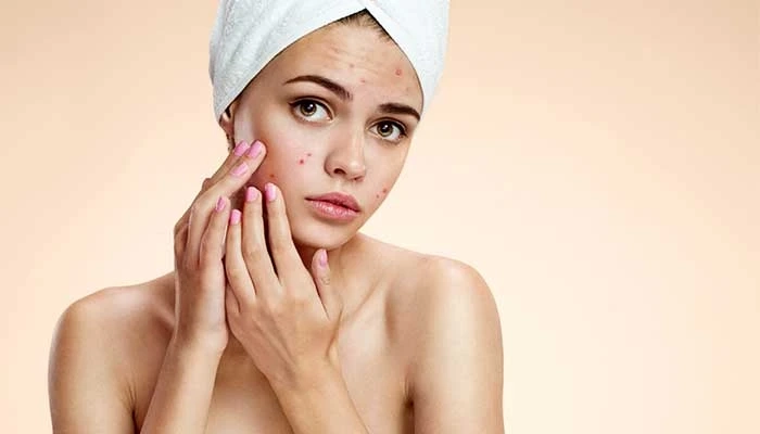 Investigating the Scientific Link Between Glutathione and Acne in Dubai