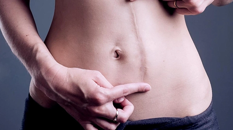 Dubai's Top Keloid Specialists: Advanced Treatment Approaches