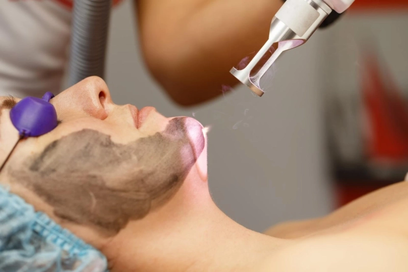 Carbon Peeling in Dubai - A Non-Invasive Skin Rejuvenation Treatment