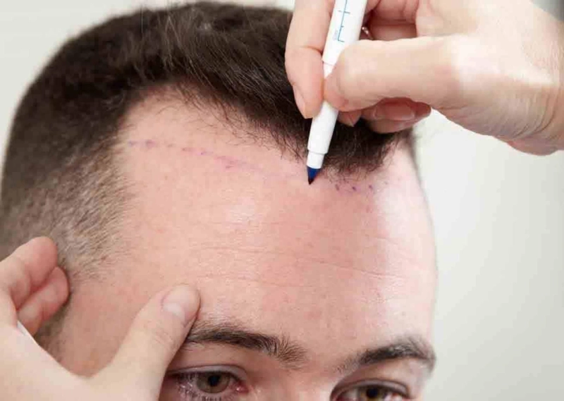 How To Find The Best Hair Transplant Clinic in Kolkata?