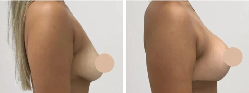 How the Best Breast Lift Surgeon in dubai Create Natural-Looking Results