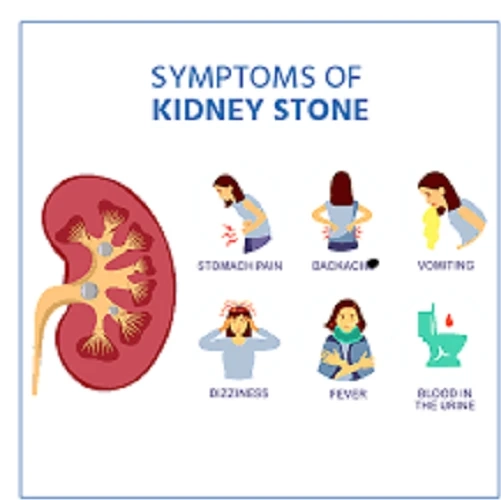 Symptoms of kidney stones