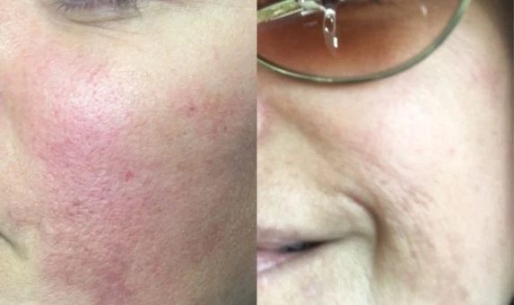 Best Chemical Peel Treatments in Queens for Glowing Skin