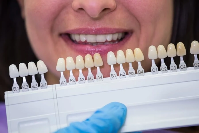 Porcelain Veneers in Dallas: Enhancing Confidence One Smile at a Time