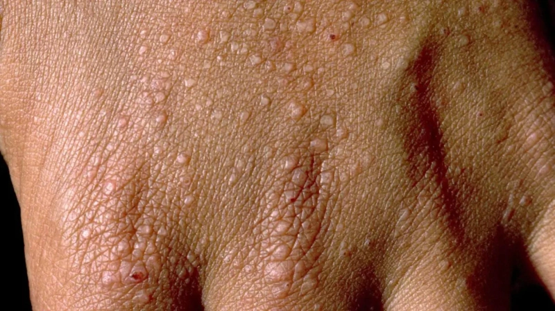 Understanding Eczema Bumps: Types, Causes, and Symptoms