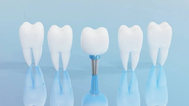 Dental Implants: What You Must Know Before Getting Started