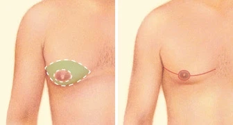 Types of Gynecomastia Surgery Procedures