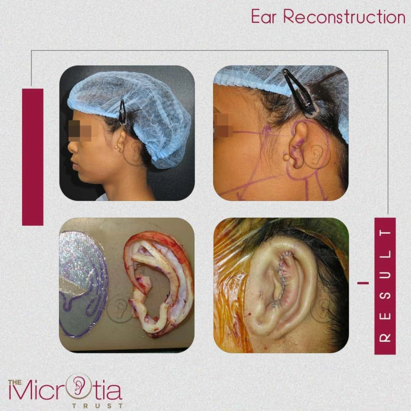 Cost of Ear Surgery in India, USA, and England