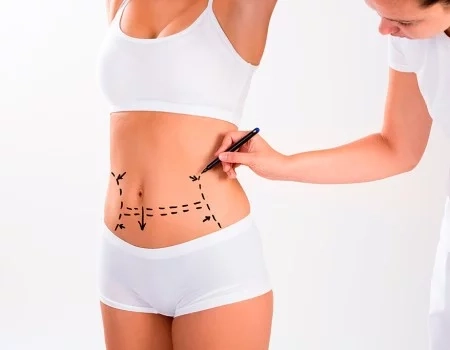 Real experiences of patients who underwent liposuction in Riyadh