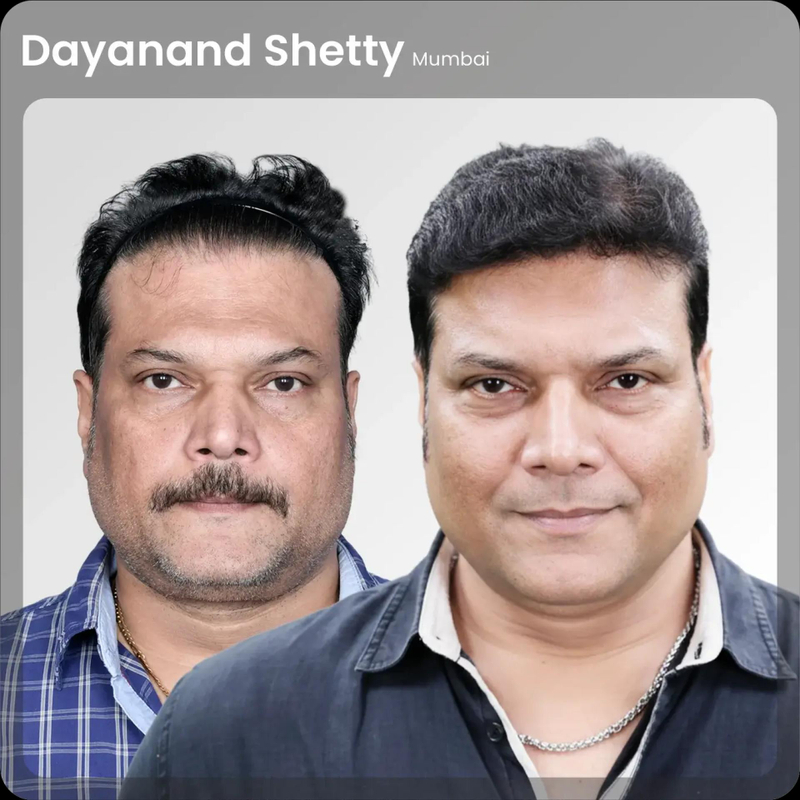 Best Hair Transplant in india | QHTClinic