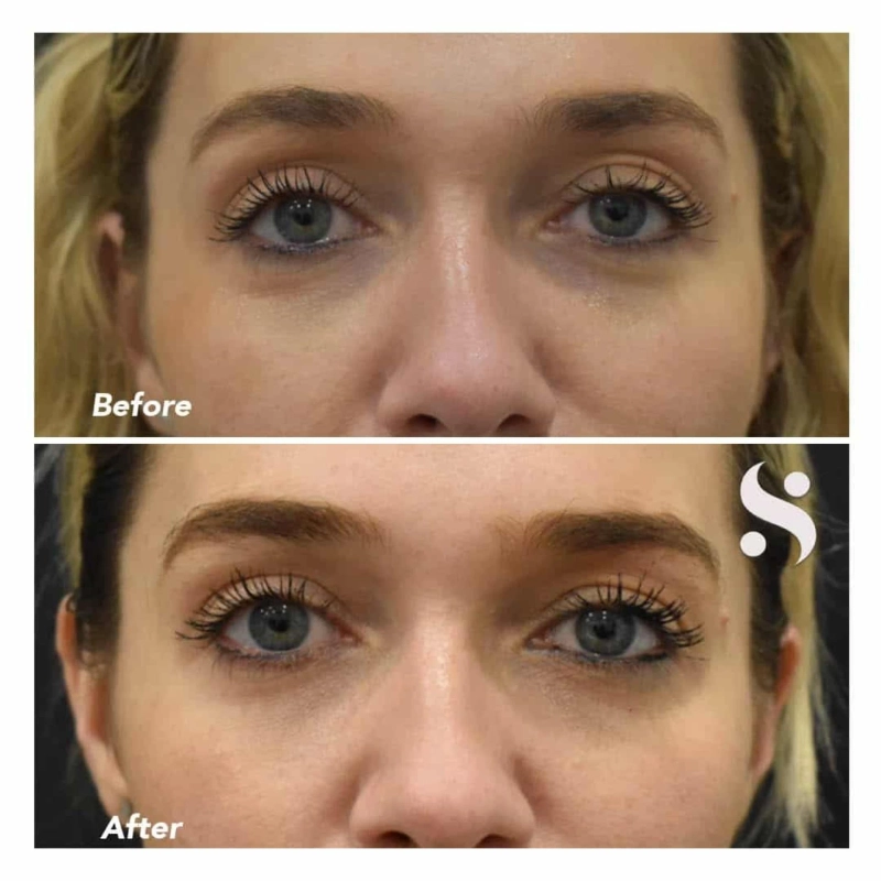 Tear Trough Dermal Filler - Serenity Athletics
