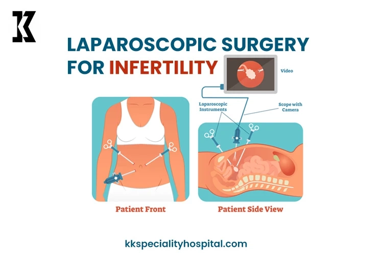 Laparoscopic Surgery for Infertility