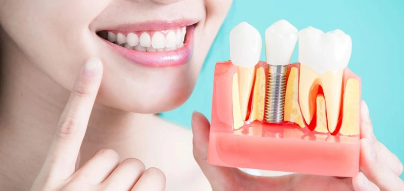 Root Canal; Guide to Procedure, Aftercare, and Common Problems