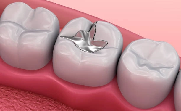 You Need a Dental Filling? Symptoms & Treatment Guide