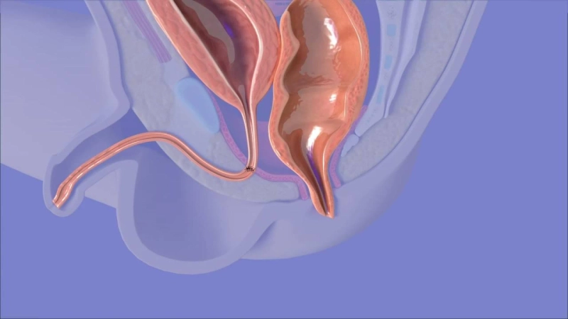 Advanced Pediatric Surgical Solutions for Anorectal Malformation in India