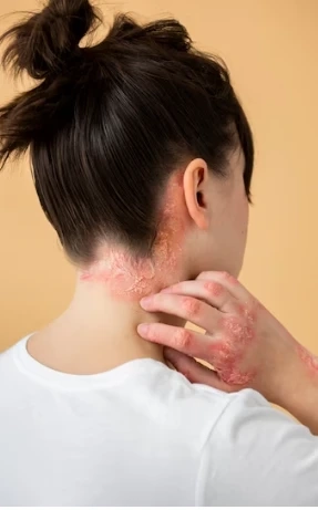 Overcoming the Challenges of Psoriasis: Coping with Itchiness and Discomfort