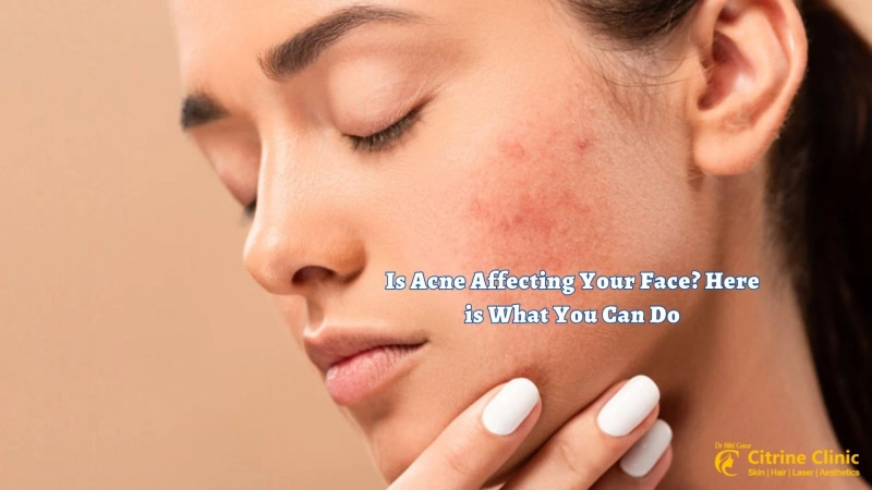 Is Acne Affecting Your Face? Here is What You Can Do