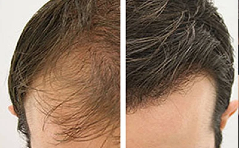 What's the Best Treatment Option for your Hair Loss?