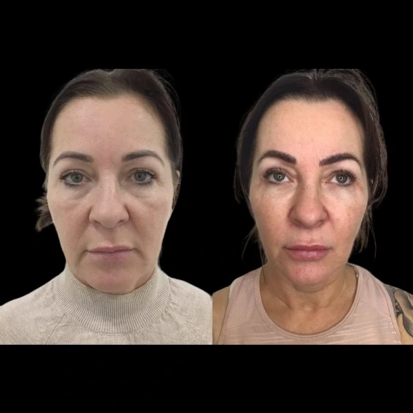 Best Doctors in Dubai for Evidence-Based Profhilo Methods