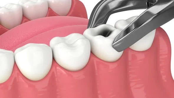 Advanced Techniques for Painless Wisdom Tooth Removal in Hinjewadi