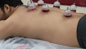 Best Hijama Cupping Center in Dwarka (Sarwarpro)