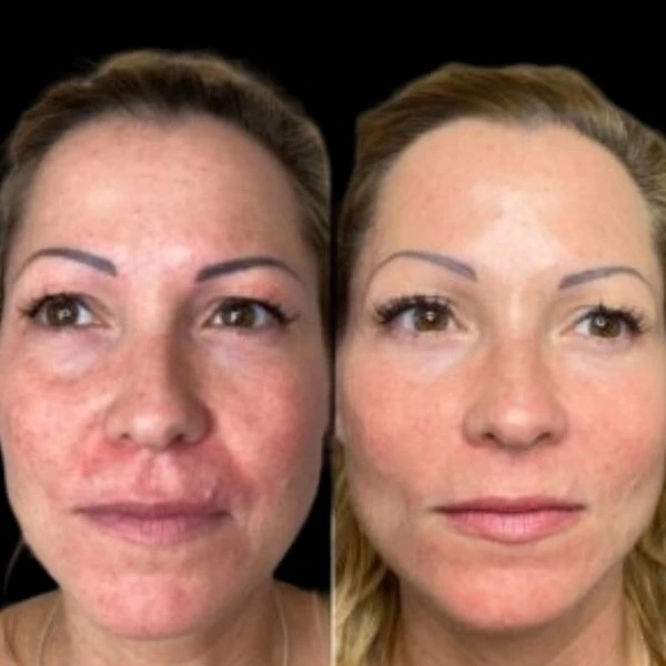 Reclaim Radiance with Profhilo from Best Doctors in dubai