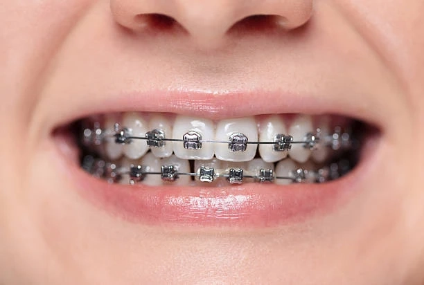 The Journey To a New Smile Start Here: Your Braces Vinings GA