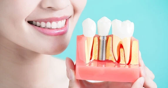 What Can You Eat After Dental Implant Treatment: A Full Guide