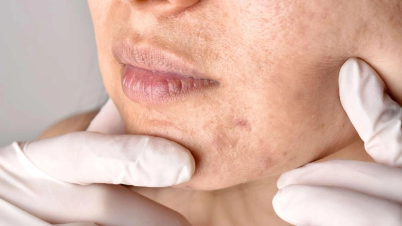 Eradicating Acne: Advanced Treatments in Dubai