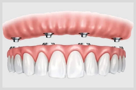 Recovery and Healing After Full Arch Dental Implants 