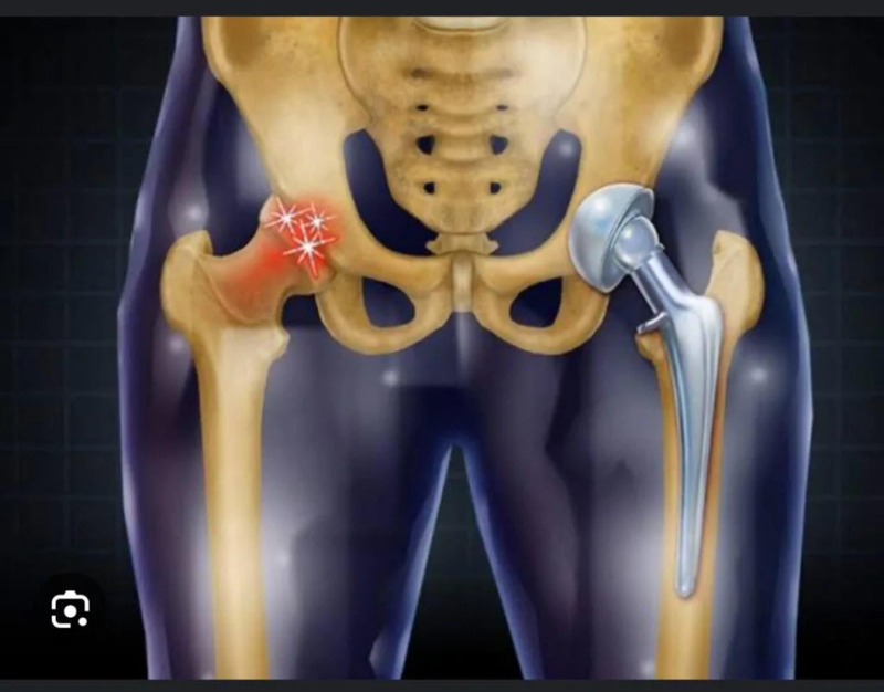 How Do Doctors Decide Between Surgery and Non-Surgical Treatment for AVN?