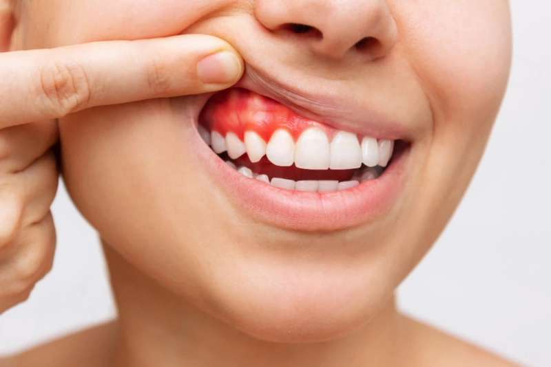 How to Recognize and Treat Hard to Spot Gum Disease: A Quick Overview