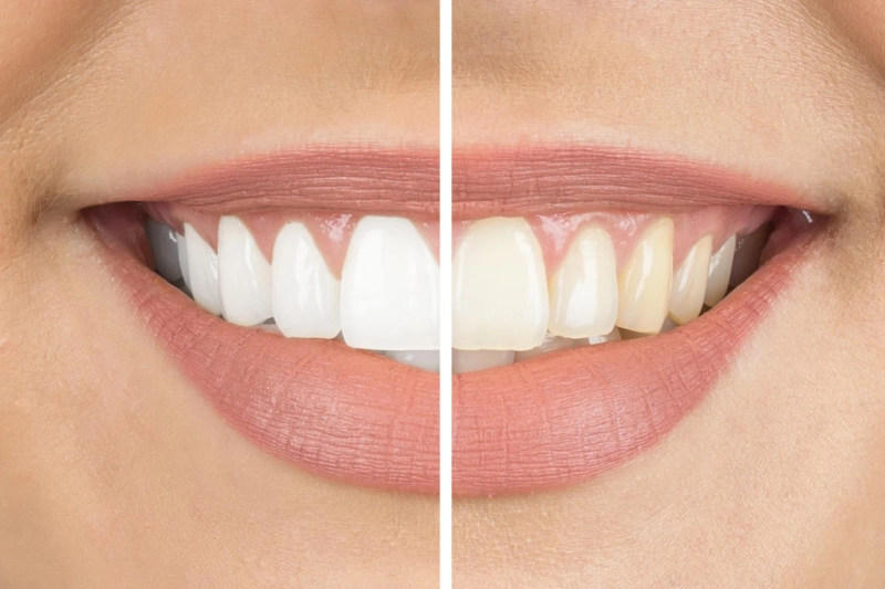 How Many Sessions Are Needed for Teeth Whitening?
