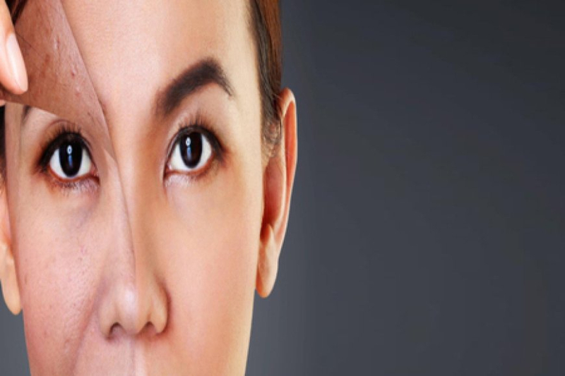 Skin Concerns Corrected By Chemical Peel Treatment