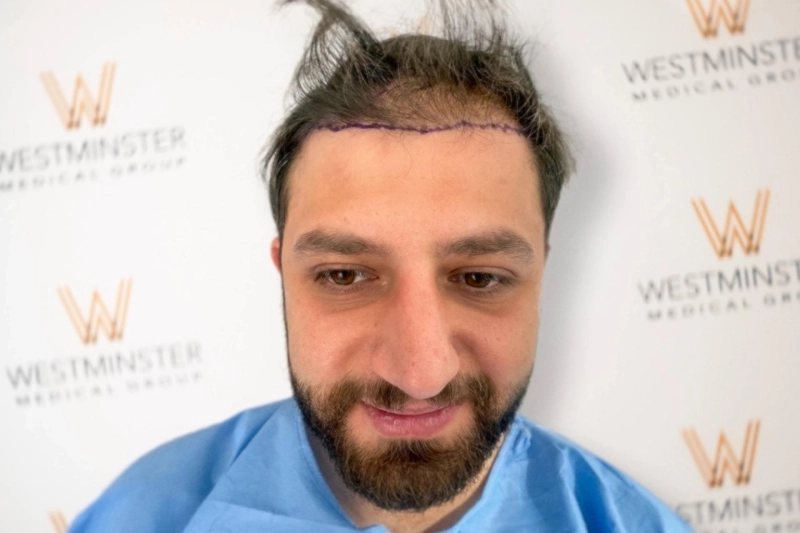 Hair Transplant Cost London: Why Transparent Pricing Matters Before Surgery