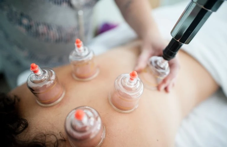 What is cupping?