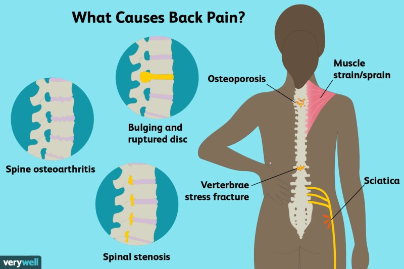 The Anatomy of Back Pain: What You Need to Know