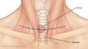 Why Do You Feel Pain In The Front Of Neck Left Side Of The Windpipe?