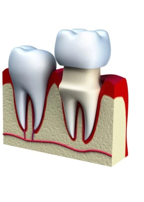 What is the use of Crowns Plumstead?