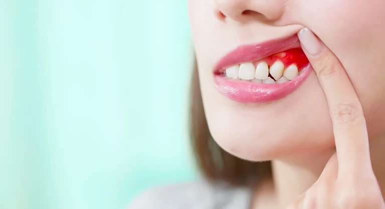 Bleeding Gums: Causes and Treatment