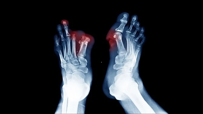 CAN STEM CELLS TREAT DIABETIC NEUROPATHY?