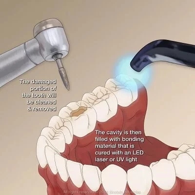 Budget-Friendly Options: Affordable Tooth Filling Alternatives