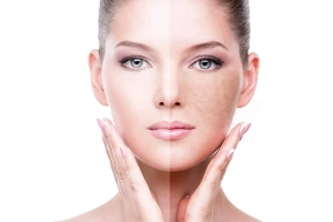 Reveal Your Glowing Skin with the Right Pigmentation Treatment