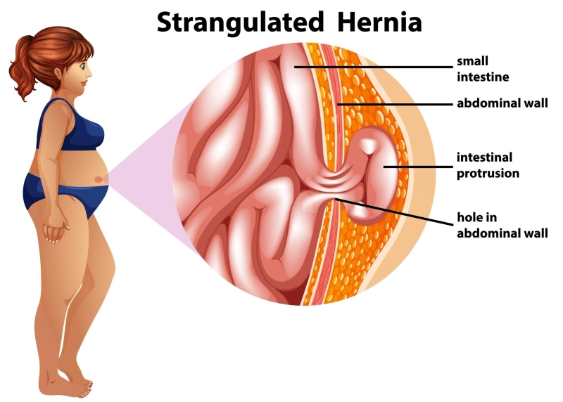 What is a Hiatal Hernia? A Complete Guide