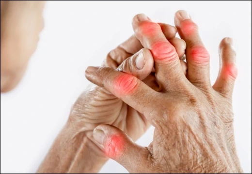 Ayurvedic Remedy for Rheumatoid Arthritis: Heal Naturally with RumoGin 5 Capsules