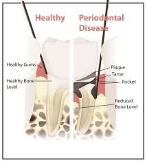How do you know if your gums are healthy?