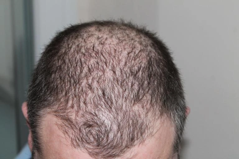 How To Find The Best Doctor For Hair Transplant in Rajasthan?