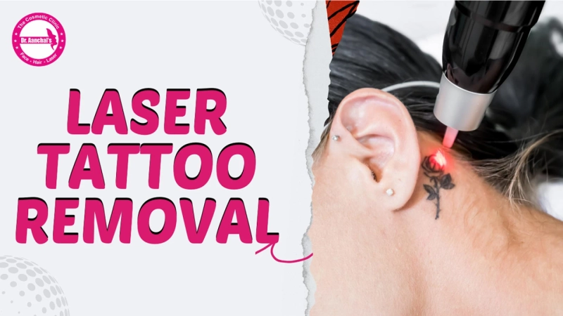 Laser Tattoo Removal in Chandigarh: Safe, Effective, and Affordable